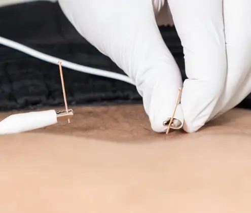 Dry Needling