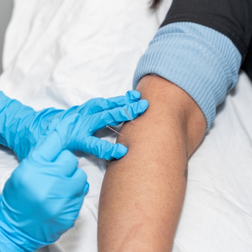 acupuncture-Aldergrove-Physiotherapy-and-Rehabilitation-Centre-Aldergrove-BC