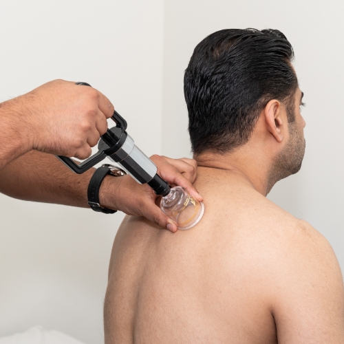 cupping-therapy-Aldergrove-Physiotherapy-and-Rehabilitation-Centre-Aldergrove-BC