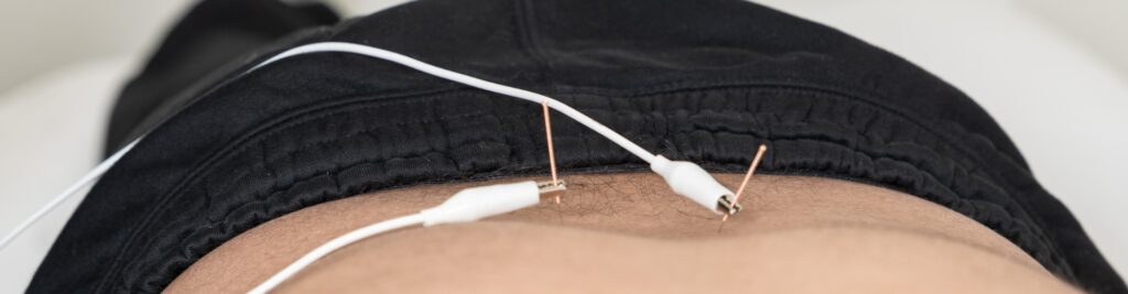 dry-needling-Aldergrove-Physiotherapy-and-Rehabilitation-Centre-Aldergrove-BC-1920x500